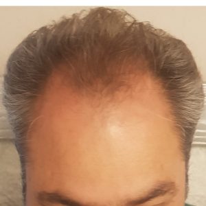 کاشت مو و ابرو اصفهان