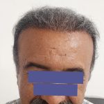 کاشت مو و ابرو اصفهان